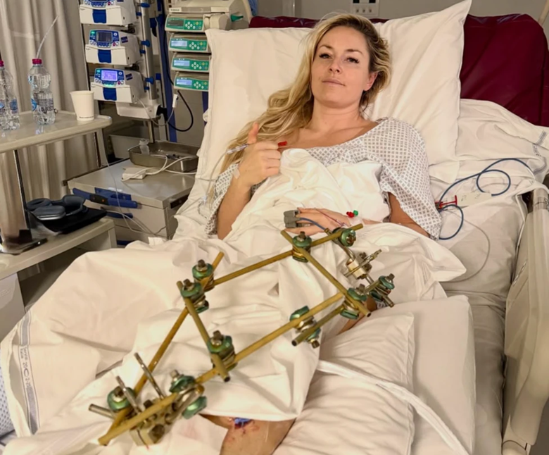 Lindsey Vonn shares an update on her broken leg suffered at the Winter Olympics. Update on February 11, 2026.